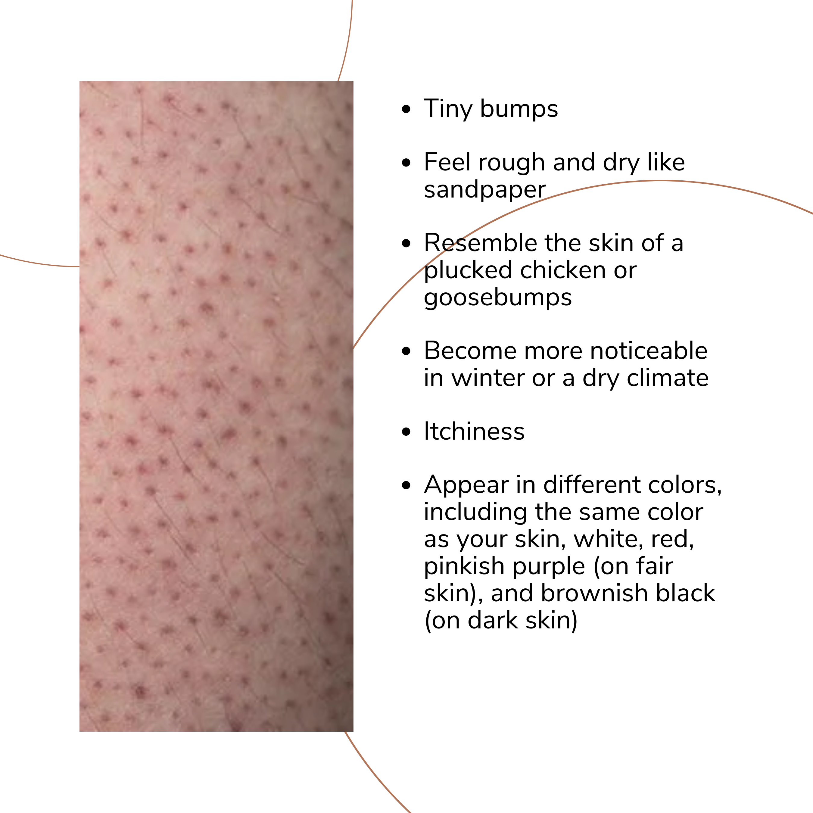 Keratosis Pilaris Dermtropics